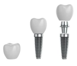 3d-dental-implants