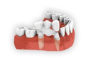 dental-crown-and-bridges